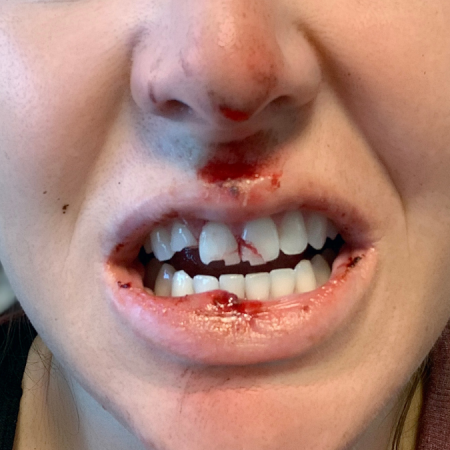 The Shocking Truth About the Day I Broke My Face